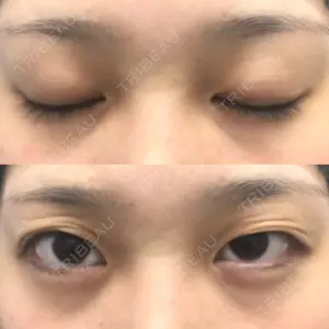 before image