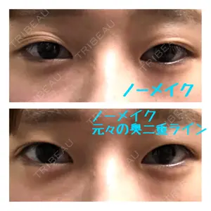 before image