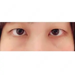 before image
