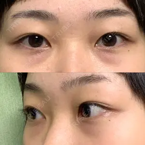before image
