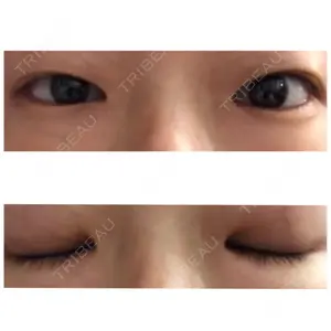 before image