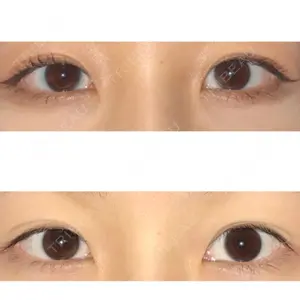 before image