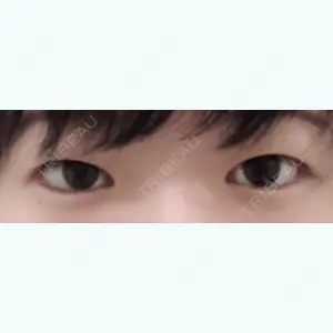 before image