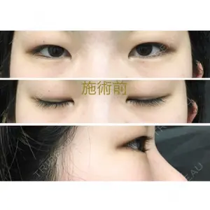 before image