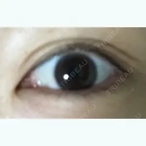 before image