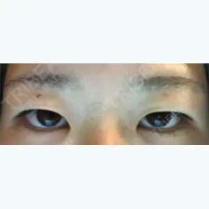 before image