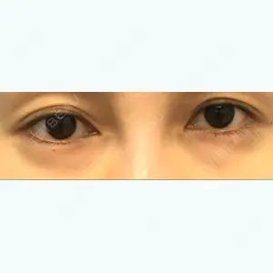 before image