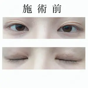 before image