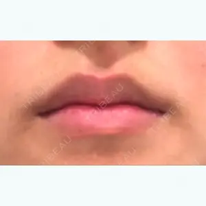 before image