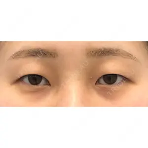 before image