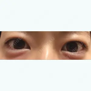 before image