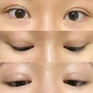 before image