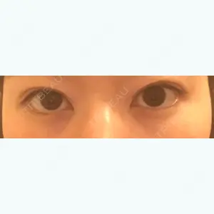 before image