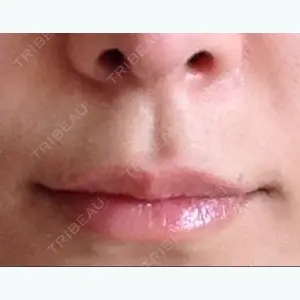 before image