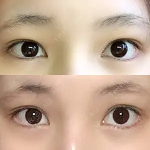 before image