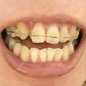 before image