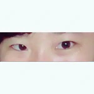 before image