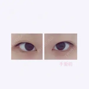before image