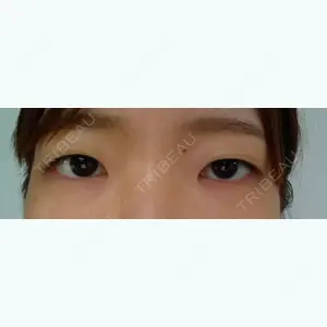 before image