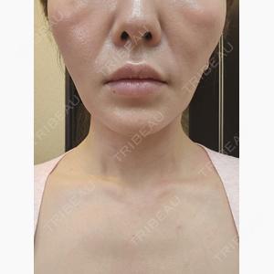 HAAB×DREAM BEAUTY CLINIC 東京本院口コミ