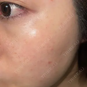 PureMe Skin Clinic（ピュアミースキンクリニック麻布）口コミ