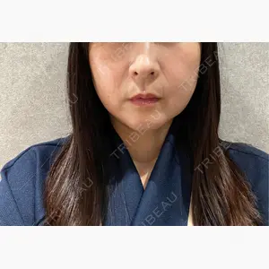 脂肪吸引ラボトウキョウ口コミ