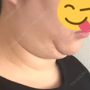 脂肪吸引ラボトウキョウ口コミ