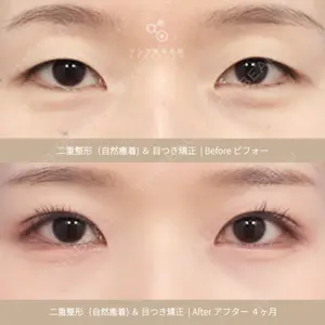 リンク美容外科 チョン・ミンス医師の症例
