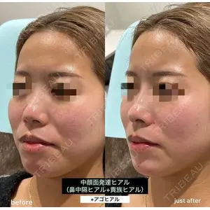 EMMO FACE CLINIC 大阪梅田院 山﨑 冴羅医師の症例