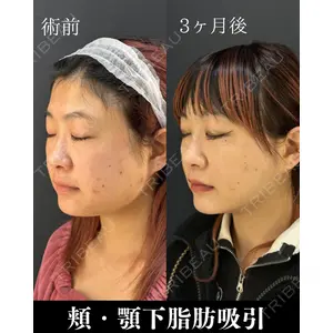 HAAB×DREAM BEAUTY CLINIC 東京本院 吉岡 修一医師の症例