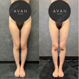 AVAN TOKYO 銀座脂肪吸引 クリニック 森脇 進医師の症例