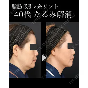 脂肪吸引ラボトウキョウ 渓 智司医師の症例
