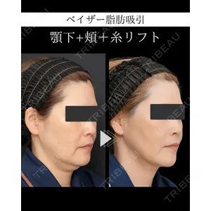 脂肪吸引ラボトウキョウ 渓 智司医師の症例