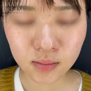HAAB×DREAM BEAUTY CLINIC 東京本院 田中 優太医師の症例
