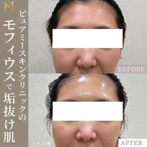 PureMe Skin Clinic（ピュアミースキンクリニック麻布） 福田 麻衣医師の症例
