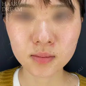 HAAB×DREAM BEAUTY CLINIC 東京本院 田中 優太医師の症例
