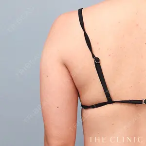BUST CLINIC（バストクリニック） 東京 大橋 昌敬医師の症例