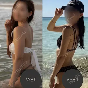 AVAN TOKYO 銀座脂肪吸引 クリニック 森脇 進医師の症例