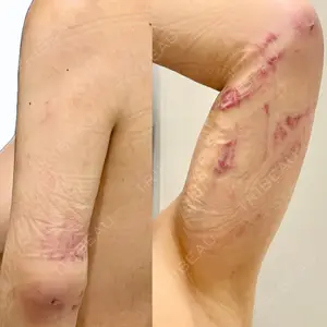 脂肪吸引ラボトウキョウ口コミ