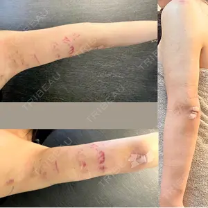 脂肪吸引ラボトウキョウ口コミ