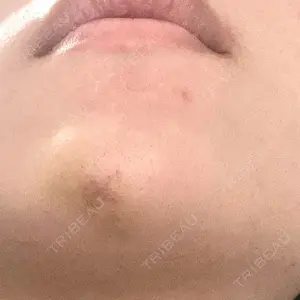 TCB東京中央美容外科 TCB東京中央美容外科 梅田茶屋町院口コミ