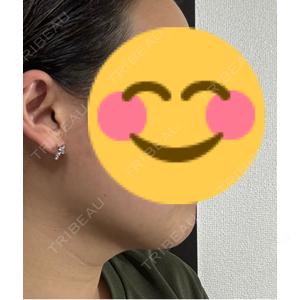 脂肪吸引ラボトウキョウ口コミ