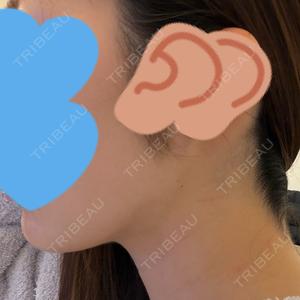 脂肪吸引ラボトウキョウ口コミ