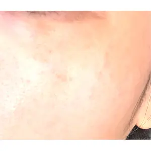 PureMe Skin Clinic（ピュアミースキンクリニック麻布）口コミ