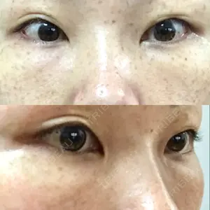 韓国ST美容整形外科口コミ