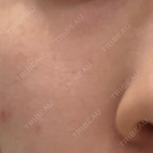 PureMe Skin Clinic（ピュアミースキンクリニック麻布）口コミ
