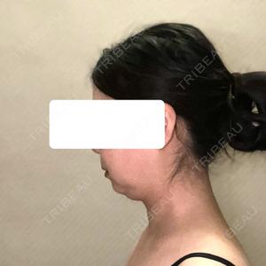 脂肪吸引ラボトウキョウ口コミ