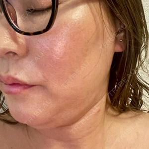脂肪吸引ラボトウキョウ口コミ