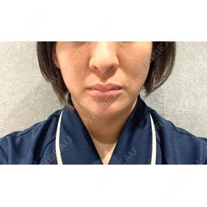 脂肪吸引ラボトウキョウ口コミ