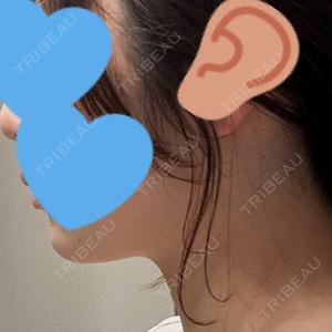脂肪吸引ラボトウキョウ口コミ